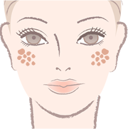 ADM(後天性真皮メラノサイトーシス)