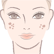 炎症後の色素沈着